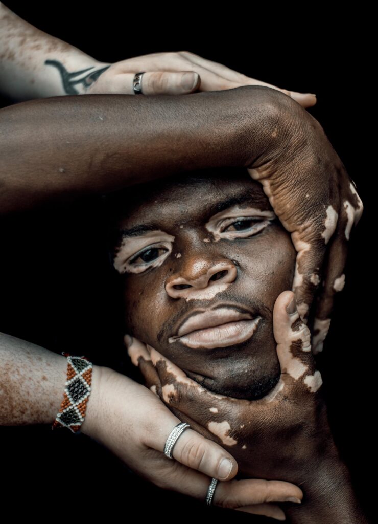 Framed by a constellation of hands with diverse skin tones and patterns, including his own, the subject with vitiligo meets the camera with quiet assurance. In this moment of intimate self-support, the photograph affirms the strength found in tenderness and the beauty of variation.By centring gestures of care and connection, the image challenges narrow ideals of masculinity and conventional beauty. It invites us to consider how identity is shaped not only by visible difference, but by the networks of solidarity, internal and external, that allow us to be fully seen.